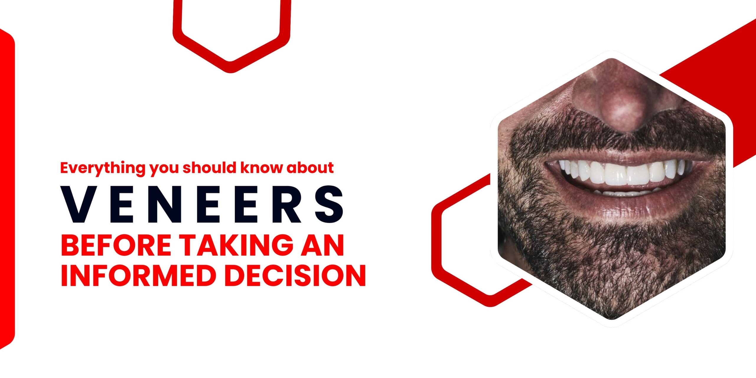 Everything you should know about veneers before taking an informed decision