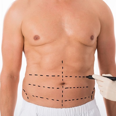 Who Is the Right Candidate for Liposuction Surgery in Islamabad